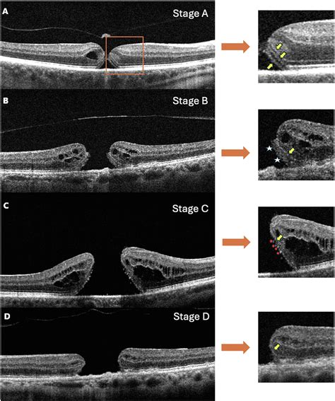 Macular Hole Staging System May Aid Surgical Planning, Predict Outcomes