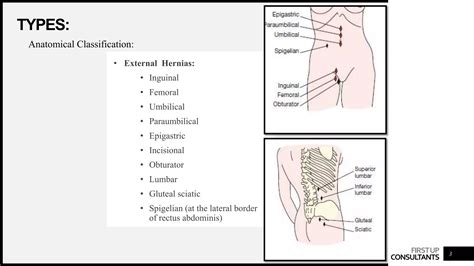 Hernias definition, types, surgical anatomy of inguinal hernia | PPTX