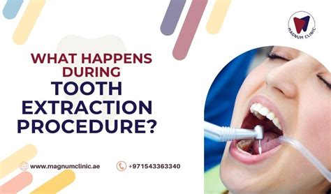 Image result for Tooth Extraction Procedure