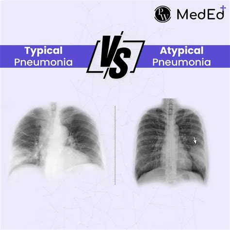 Atypical Pneumonia Vs Typical Pneumonia