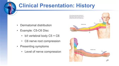 Cervical radiculopathy | PPTX
