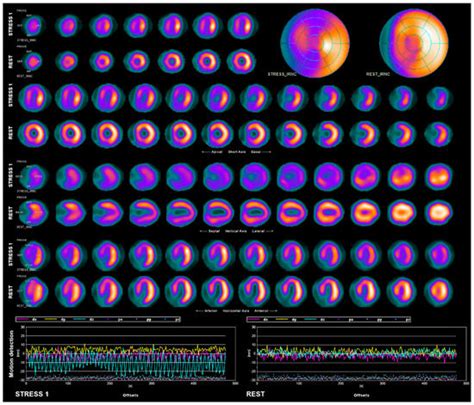 Mask-Related Motion Artifact on 99mTc-MIBI SPECT: Unexpected Pitfalls ...