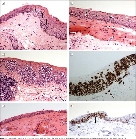 Primary Acquired Melanosis