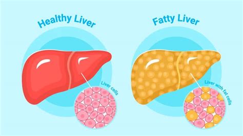 Sleep-Liver Connection: How Sleep Apnea Impacts Liver Health? Expert ...