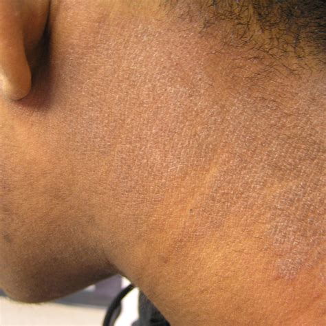 why doctor's struggle to identity eczema on darker tones Background