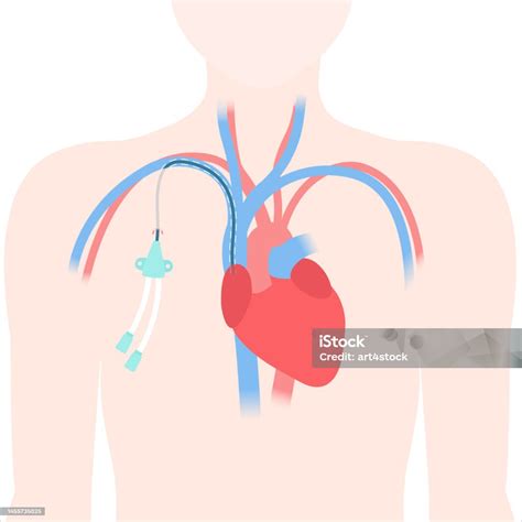 Tunneled Central Line Venous Catheter Medical Diagram Stock Illustration - Download Image Now ...