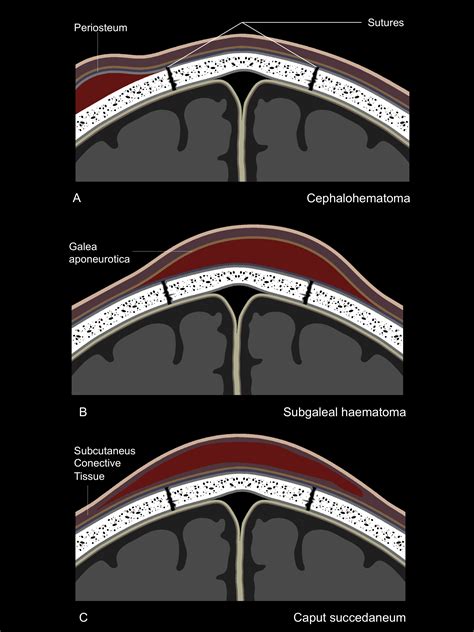 Caput Vs Cephalohematoma