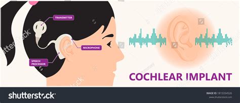 Image result for Cochlear
