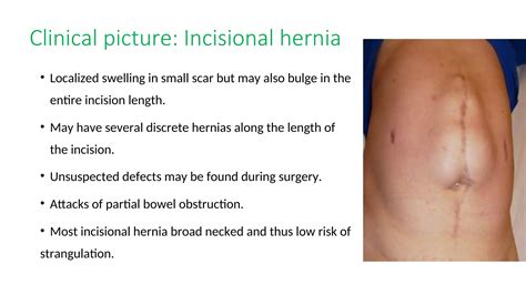 VENTRAL HERNIA - Abdominal Wall Reconstruction AWR - Surgery -Repair ...