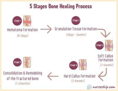 Image result for Bone Healing Process