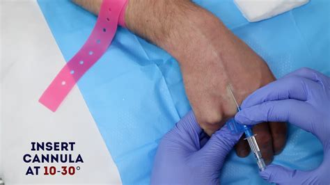 Intravenous Cannulation Procedure - OSCE Guide | Geeky Medics