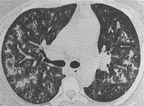Hypersensitivity Pneumonitis | AJR