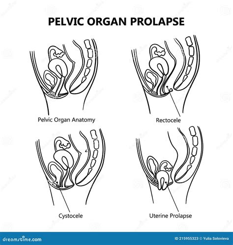 PELVIC ORGAN PROLAPSE VARIOUSLY MONOCHROME Education Vector Set Stock ...