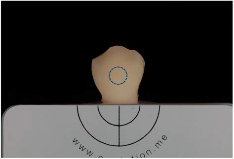 Tooth Discoloration after Regenerative Endodontic Procedures with ...