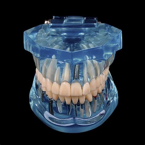 Buy Dental Implant Model Teeth Typodont Model Dental Implant ...