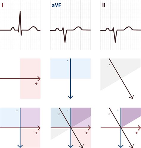 Estimating Cardiac Axis | ECG Basics - MedSchool