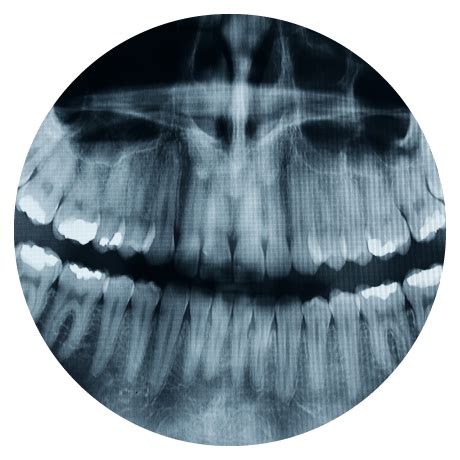 Tooth Extraction - Edmonton, Alberta | Ellerslie 66 Dental