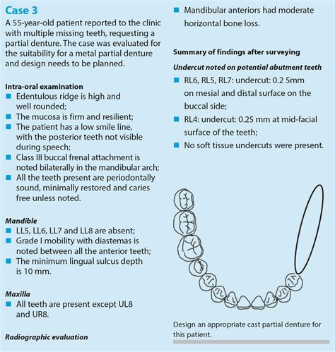 Image result for Partial Denture Procedure