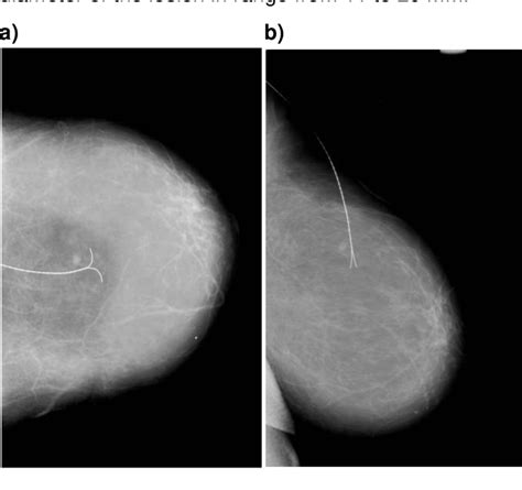 Wire Localization Procedure 的图像结果