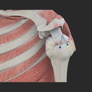 Image result for Rotator Cuff Repair Photo