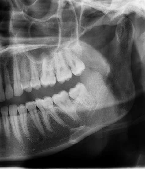 Dental Abscess X Ray Dog at Layla Helms blog