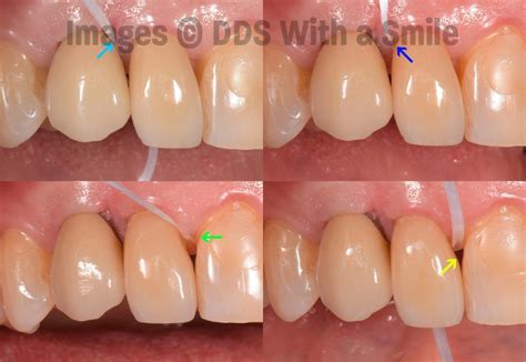 Tooth Recession 的图像结果