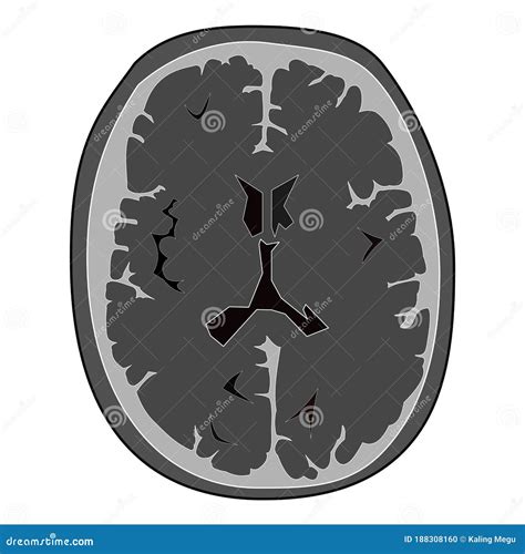 Image result for Normal Brain CT Scan
