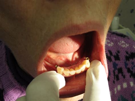 Dental Implants – Before and After | Portland Dentures & Dental Implants