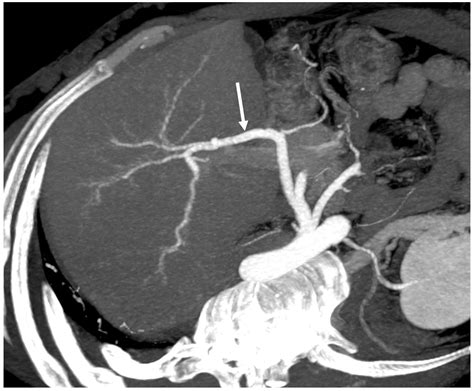 Budd-Chiari Syndrome Imaging Diagnosis: State of the Art and Future ...