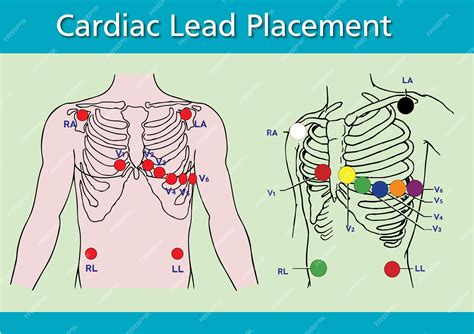 Premium Vector | Cardiac Lead Placement