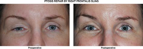 Image result for Levator Resection Surgery