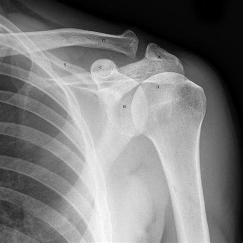Acromioclavicular (AC) Joint Injuries – Core EM