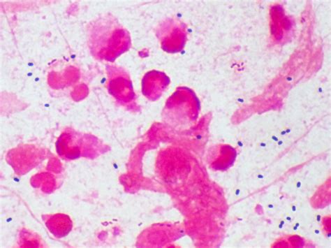 Haemophilus influenzae〔インフルエンザ桿菌〕 | グラム染色: Gram Stain