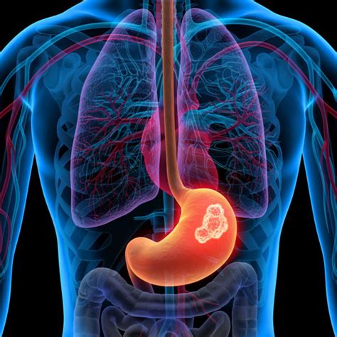 GASTEA | Cáncer de estómago | Síntomas y tratamiento