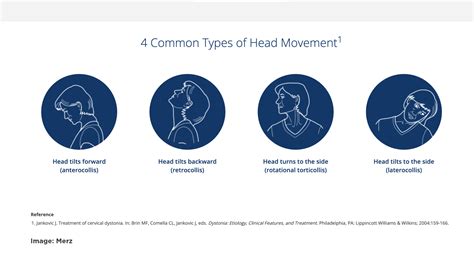 Cervical Dystonia Symptoms and Treatment Options