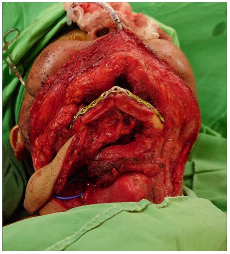 Adjustable Single-Osteotomy Fibular Free Flap for Anterior Mandibular Defects in Irradiated Head ...