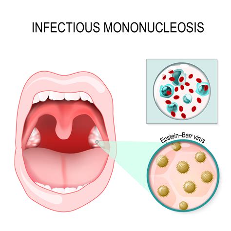 Infectious Mononucleosis PPT - Morphologic and Distributive Leukocyte ...