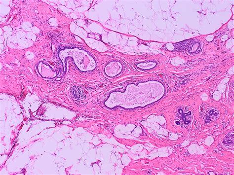 Pathology Outlines - Nonproliferative fibrocystic changes