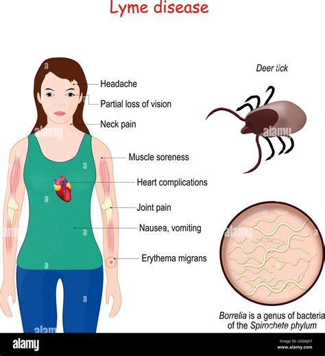 Lyme disease. Close-up of Deer tick. Magnification of Borrelia (bacteria of the Spirochete ...