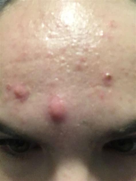 [Acne] Angry red pimples on forehead and cheeks : r/SkincareAddiction