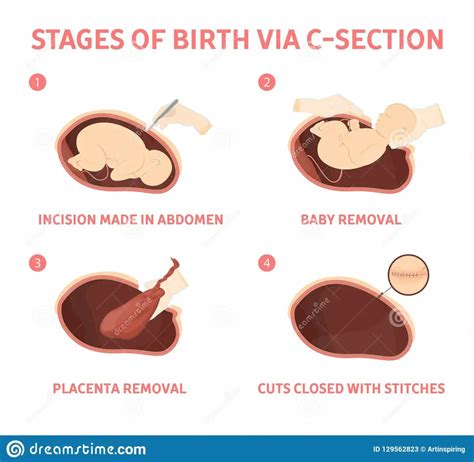Birth: the stages of cesarean section - Healthy Food Near Me