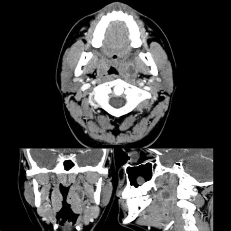 Pediatric Peritonsillar Abscess | Pediatric Radiology Reference Article | Pediatric Imaging ...