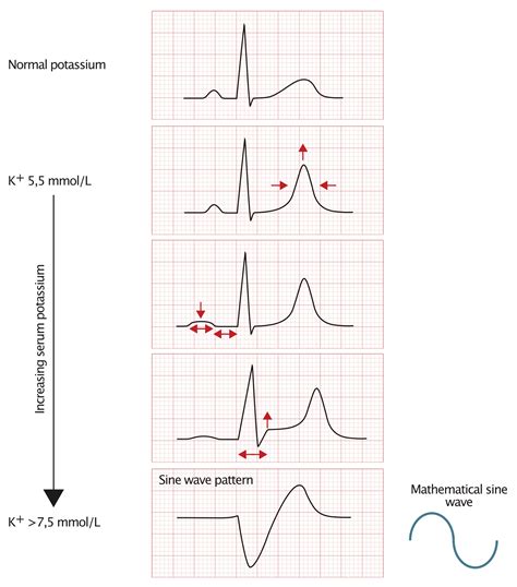 ECG changes due to electrolyte imbalance (disorder) – The Cardiovascular