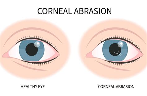 Cornea Damage Symptoms
