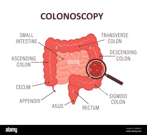 Image result for Colonoscopy Polypectomy