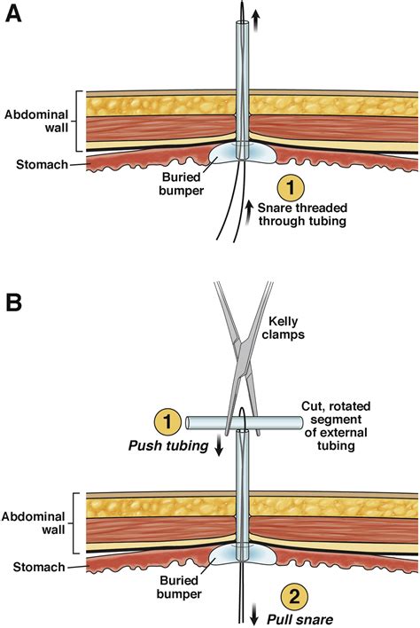 Buried Bumper Syndrome