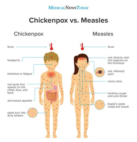 Chickenpox vs. measles: Symptoms, pictures, treatment, and more