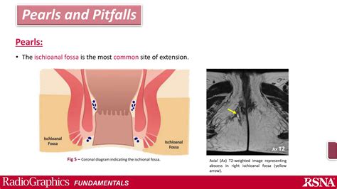 Perianal fistula and Abscess.pptx