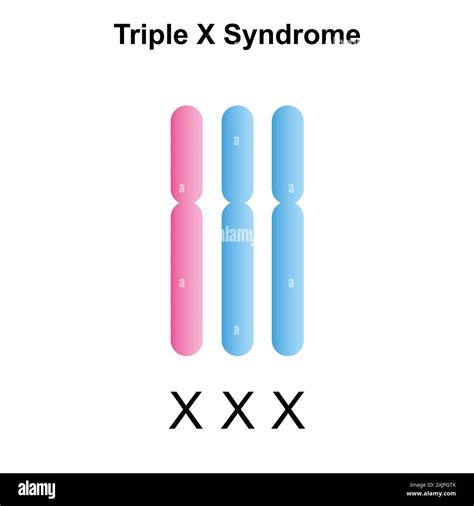 Trippel X Syndrom Karyotype Changes In The Cohort Composition Of