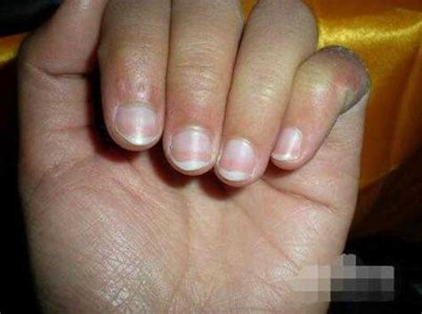 灰指甲 甲癬 真菌感染 - 妮寶貝指甲